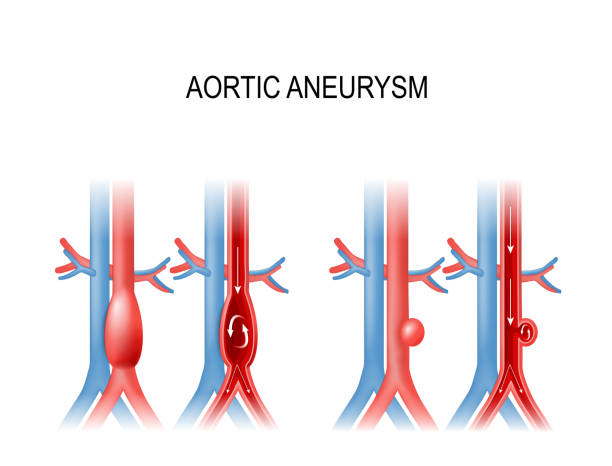 aortic aneurysm