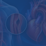 Aortic Dissection Type A Surgery