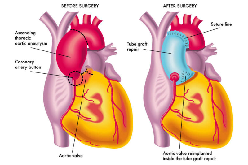 Aortic Valve Repair & Replacement Surgery in Mumbai, Aortic Valve ...