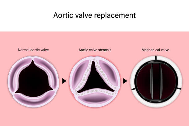 aortic valve repair