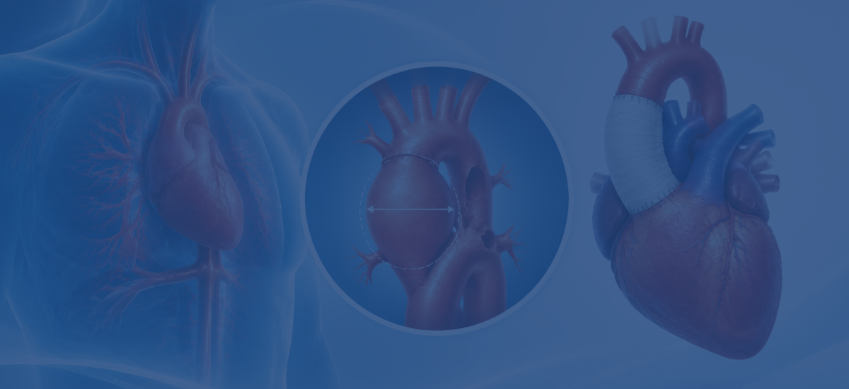 Ascending Aortic Aneurysm 5.5 Cm Surgery