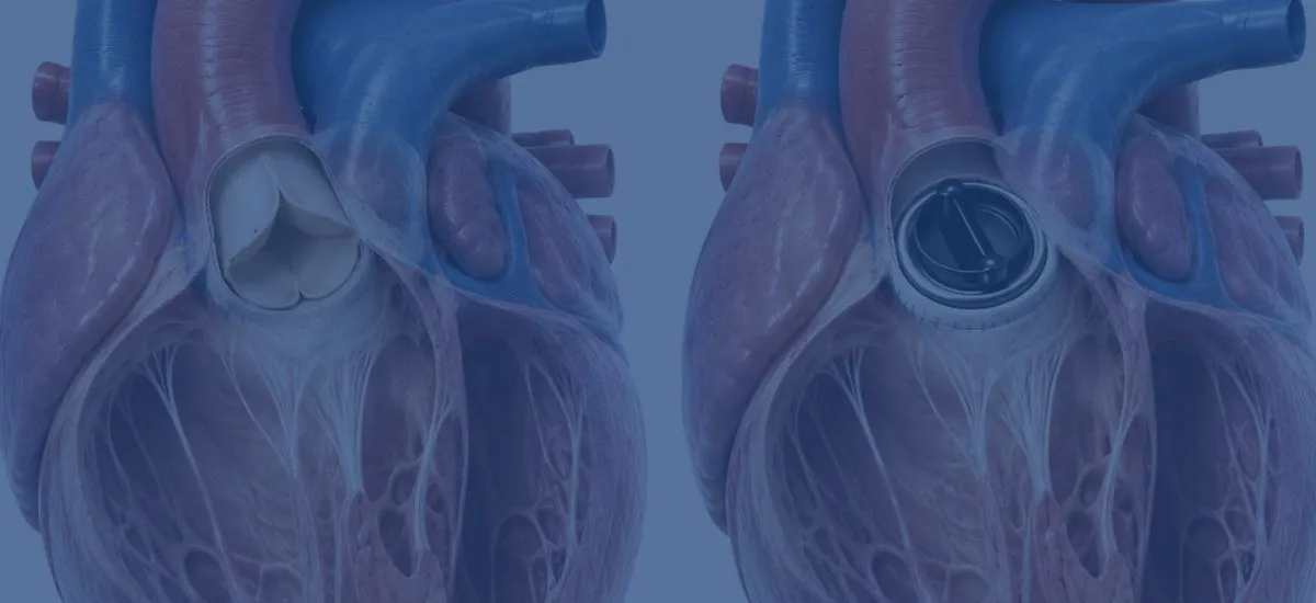 Congestive Heart Failure At 40