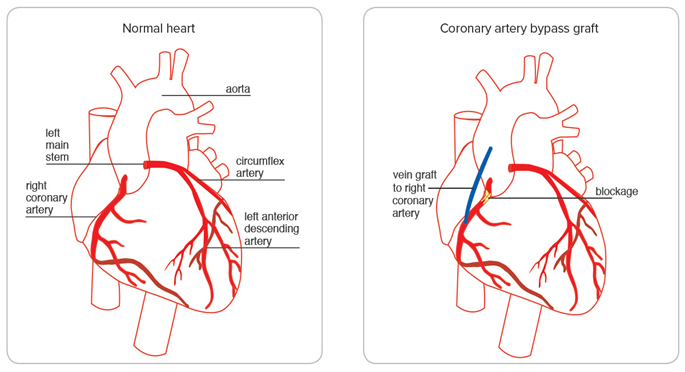 Coronary Artery Bypass Graft (cabg)