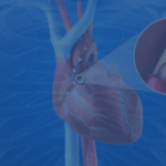How Coronary Artery Bypass Graft Surgery Improves Blood Flow And Prevents Future Heart Attacks