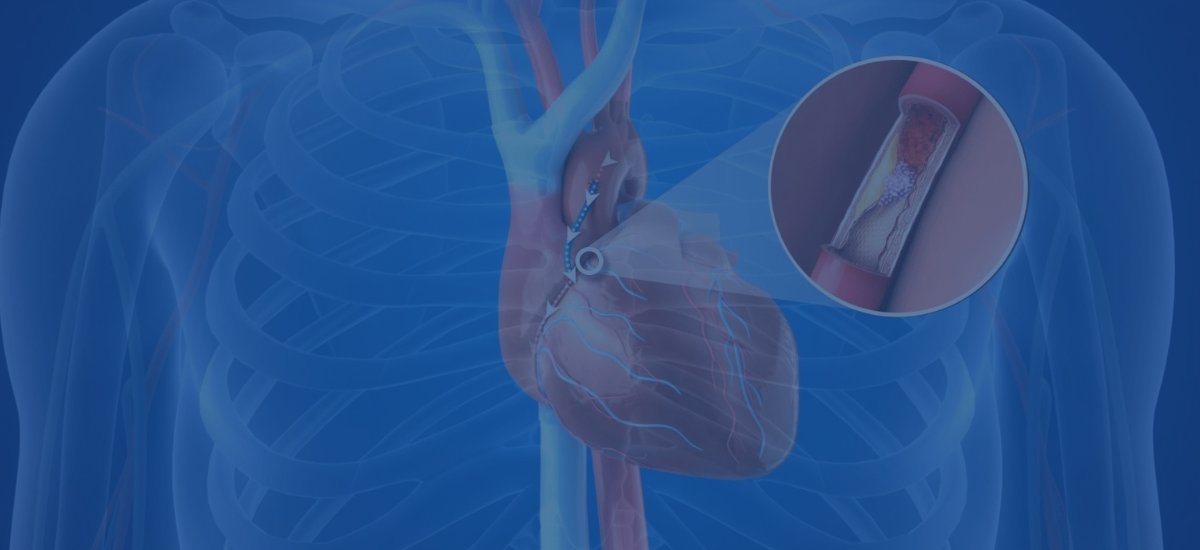 How Coronary Artery Bypass Graft Surgery Improves Blood Flow And Prevents Future Heart Attacks