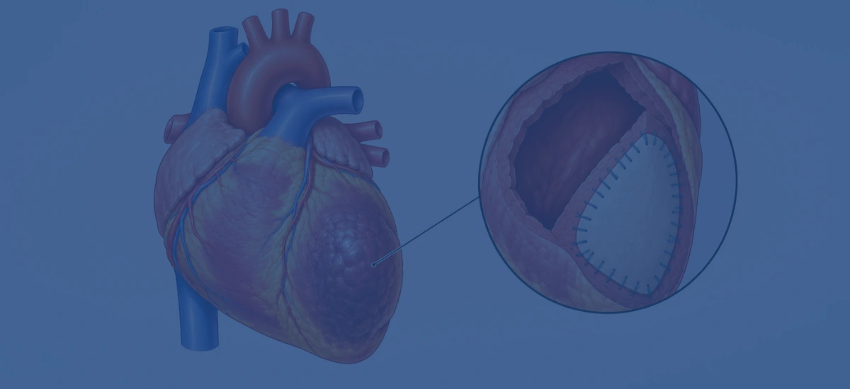 How Is A Left Ventricular Aneurysm Repaired | Dr. Vishal Khullar How Is A Left Ventricular Aneurysm Repaired