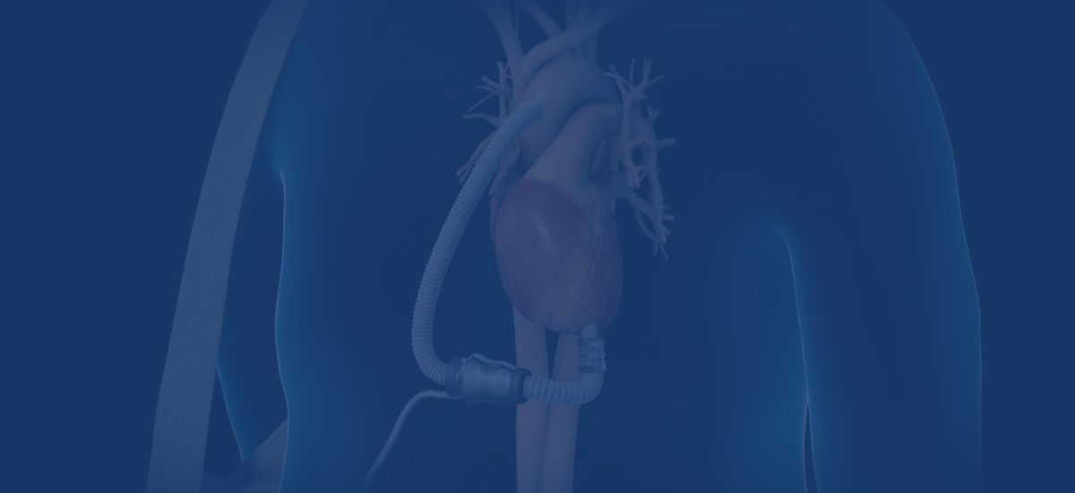 Living And Caring For Yourself With An Lvad