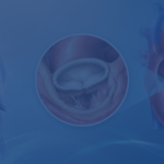 Mini Thoracotomy Mitral Valve Repair