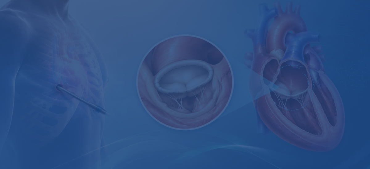 Mini Thoracotomy Mitral Valve Repair
