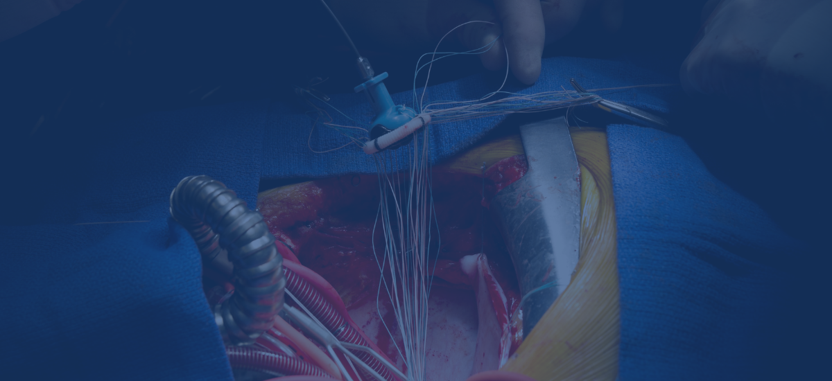 Mitral Valve Stenosis Dr. Vishal Khullar