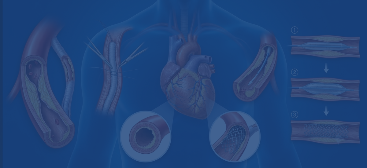 Redo Bypass vs Angioplasty: Which for Blocked Grafts
