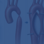 What Is Aortic Coarctation Repair