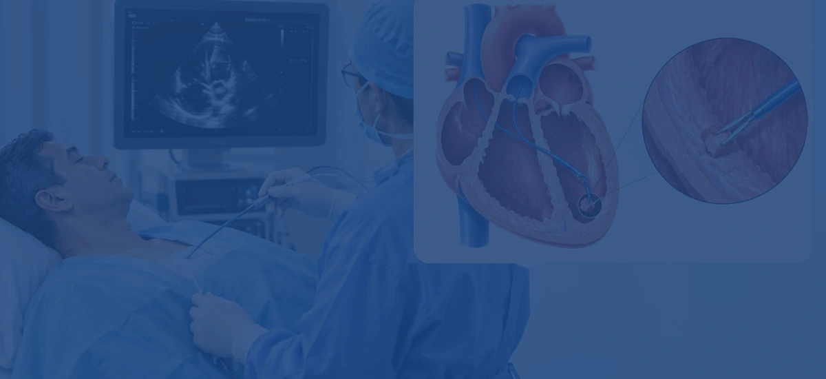 What Is Endomyocardial Biopsy After Heart Transplant | Dr. Vishal Khullar What Is Endomyocardial Biopsy After Heart Transplant