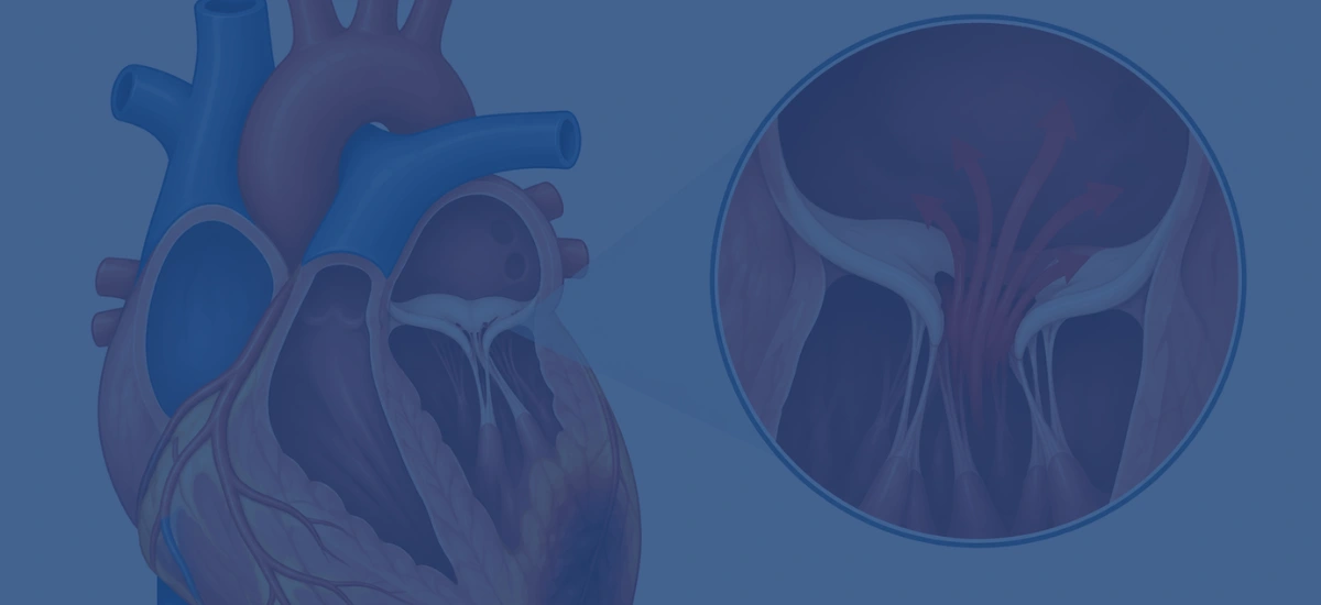 What Is Ischemic Mitral Regurgitation After A Heart Attack | Dr. Vishal Khullar What Is Ischemic Mitral Regurgitation After A Heart Attack