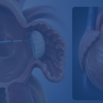 What Is Left Atrial Appendage Closure And Who Needs It