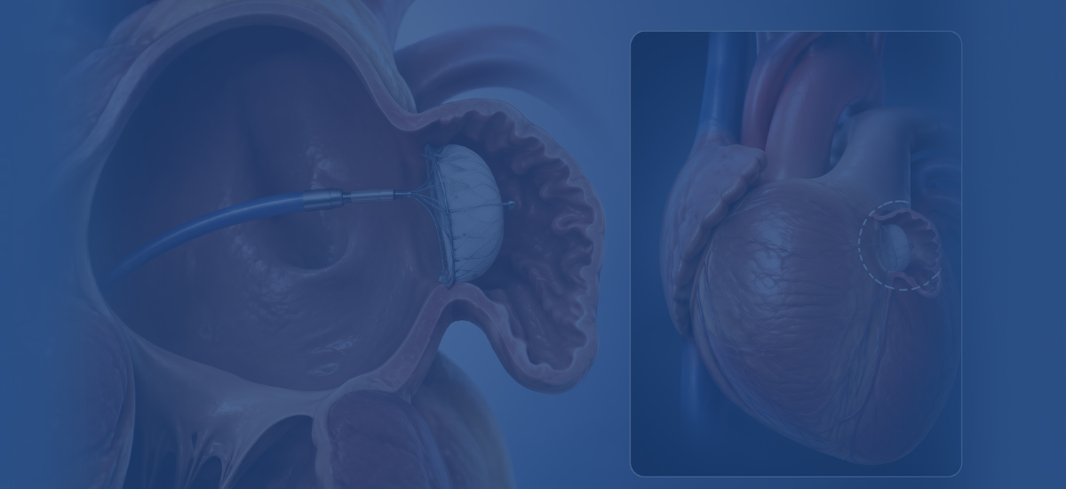 What Is Left Atrial Appendage Closure And Who Needs It