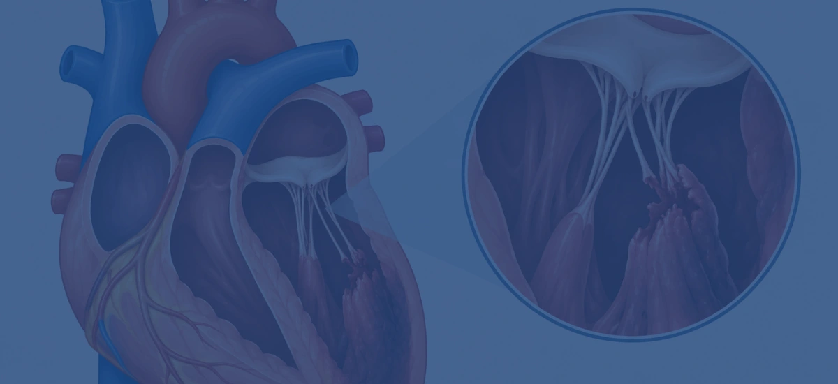 What Is Papillary Muscle Rupture After A Heart Attack | Dr. Vishal Khullar What Is Papillary Muscle Rupture After A Heart Attack