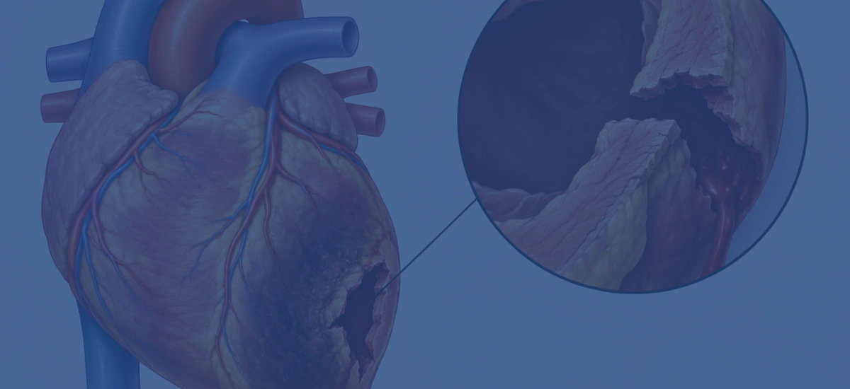 What Is Ventricular Free Wall Rupture After A Heart Attack | Dr. Vishal Khullar What Is Ventricular Free Wall Rupture After A Heart Attack