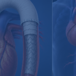 What Is A Frozen Elephant Trunk Procedure