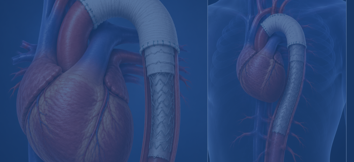 What Is A Frozen Elephant Trunk Procedure