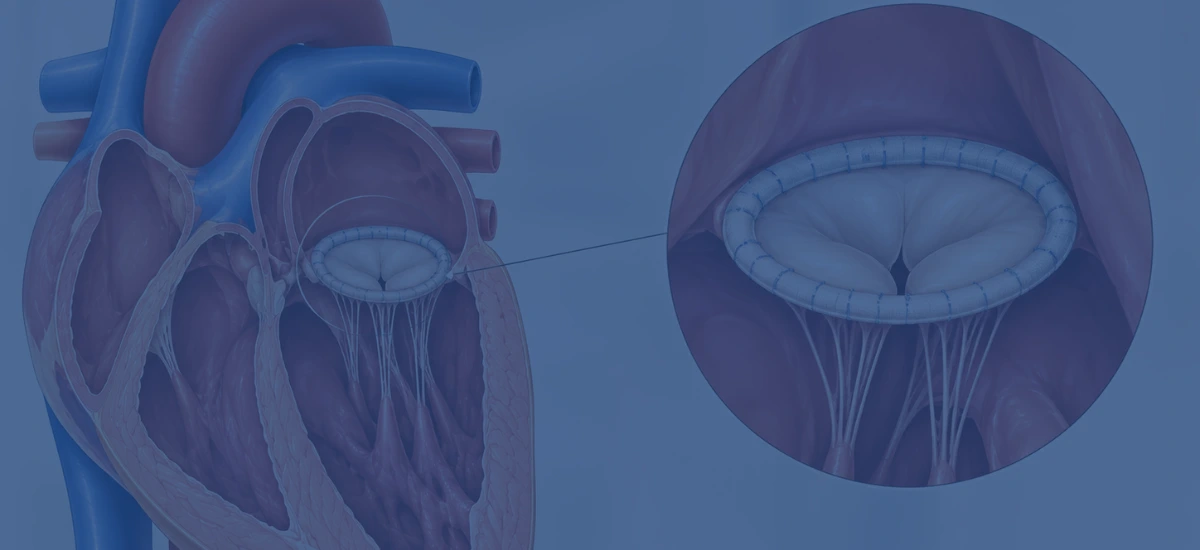 What Is An Annuloplasty Ring In Mitral Valve Repair | Dr. Vishal Khullar What Is An Annuloplasty Ring In Mitral Valve Repair
