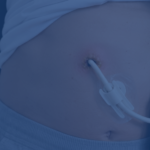 What Is An Lvad Driveline Infection