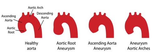 Aorta