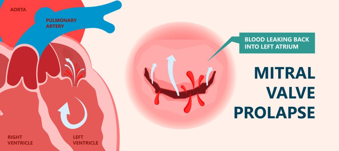 Mitral Valve Prolapse Surgery