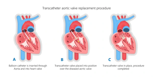 Transcatheter Arotic